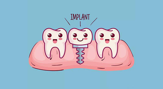 dental implant